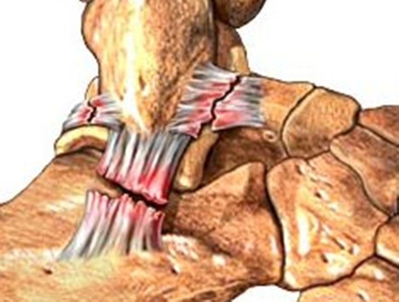 Διάστρεμμα και θεραπεία