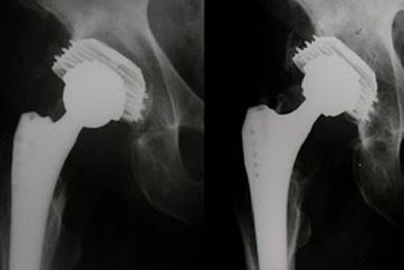 Κάταγμα Κοτύλης