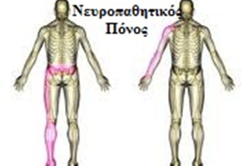 Νευροπαθητικός πόνος