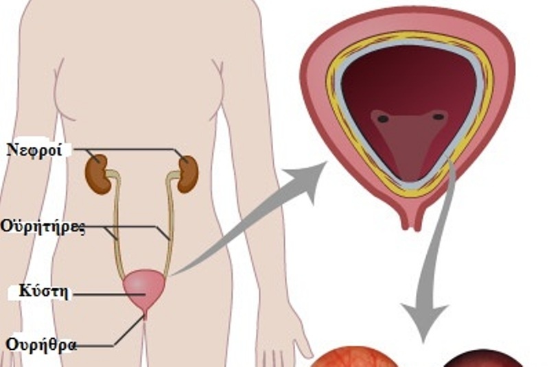 Διάμεση Κυστίτιδα