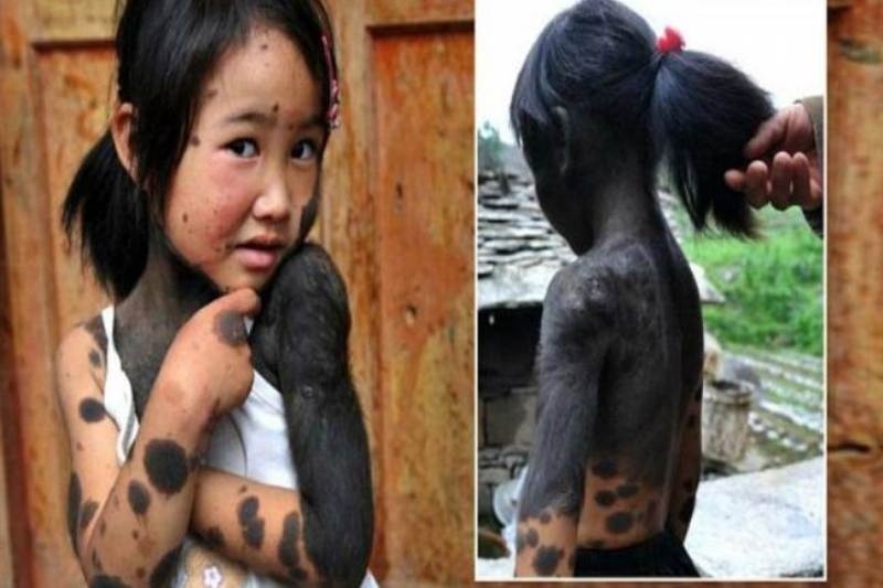 H τραγική ιστορία μιας 6χρονης που πάσχει από έντονη τριχοφυϊα