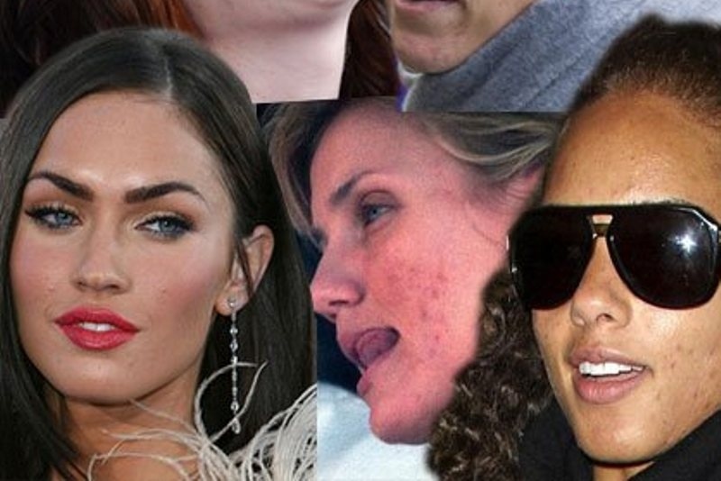 Ποιος είπε πώς οι celebrities δεν έχουν ακμή;