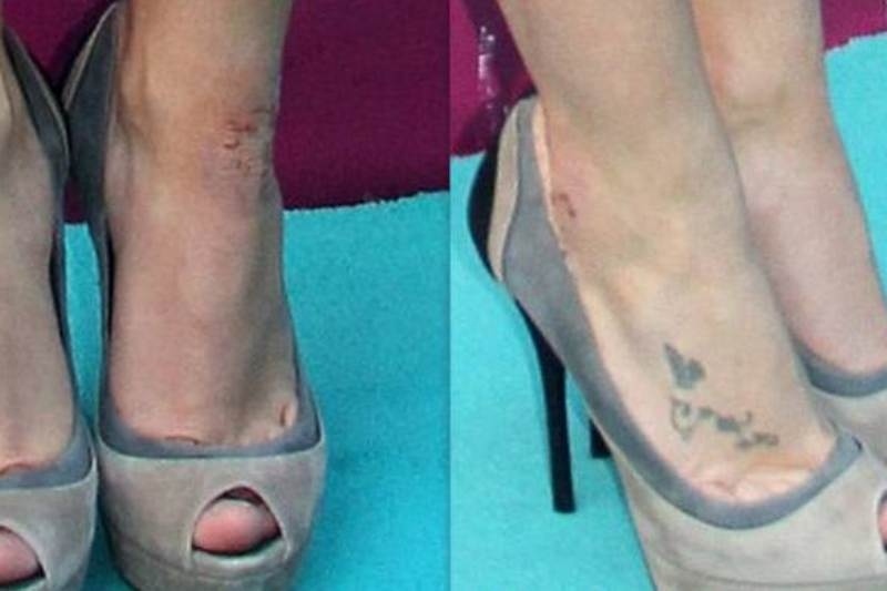 Το άγχος... της έχει προκαλέσει ψωρίαση! (photo)