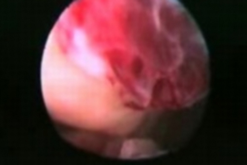 Συγκλονιστικό! Καρέ καρέ σε βίντεο η ανθρώπινη ωορρηξία