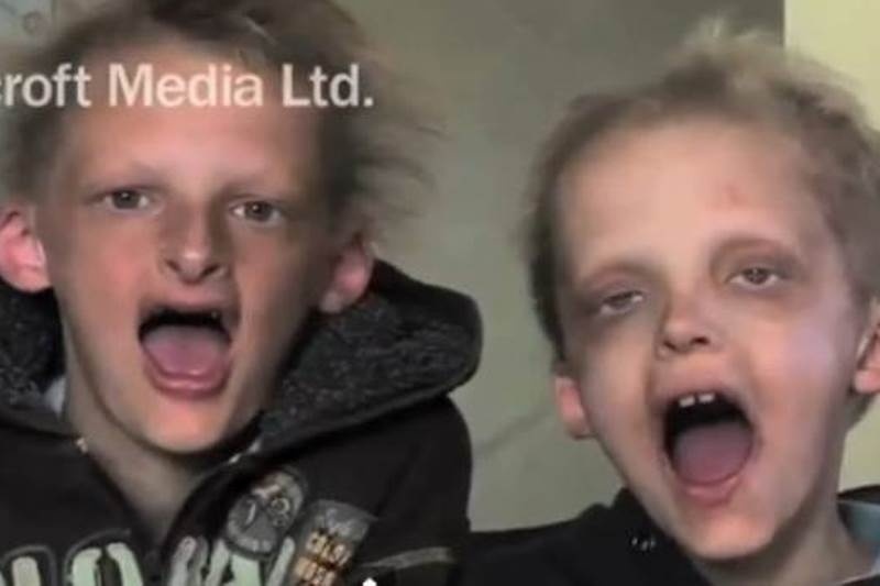 Αδέλφια πάσχουν από ασθένεια παρόμοια με τον… βαμπιρισμό! (βίντεο)