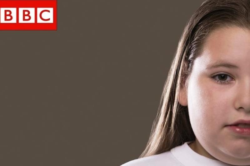 Μετάλλαξη γονιδίου οδηγεί στην παχυσαρκία