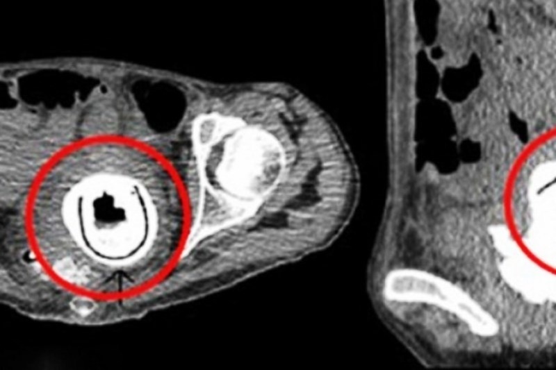 «Ξεχασμένο» sex toy βρισκόταν στον κόλπο της επί 10 χρόνια...