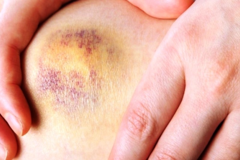 Πώς θα απαλλαγείτε γρηγορότερα από τις μελανιές