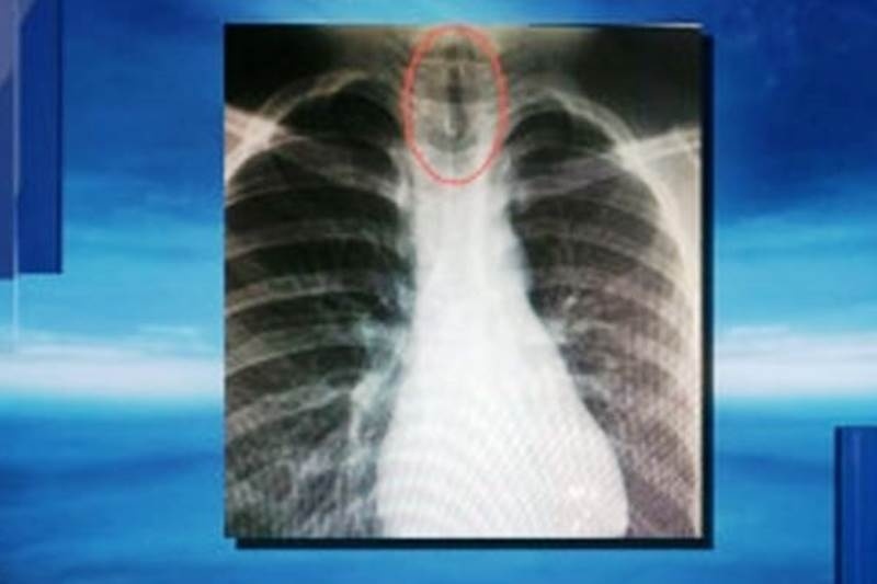 Απίστευτο: Δείτε τι βρήκαν οι γιατροί στον πνεύμονα 11χρονου αγοριού (photos)