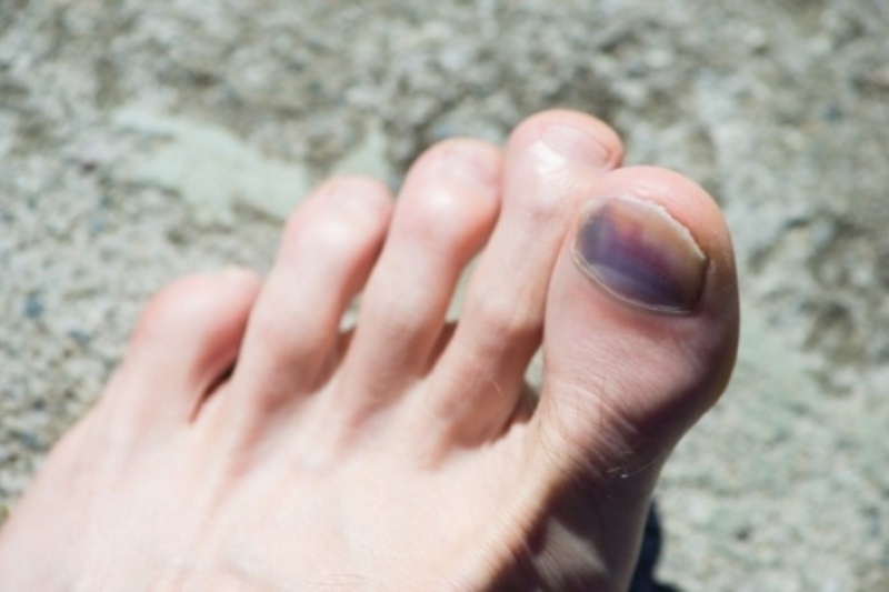 Χτυπημένο νύχι: Τι να κάνετε για να μην μαυρίσει