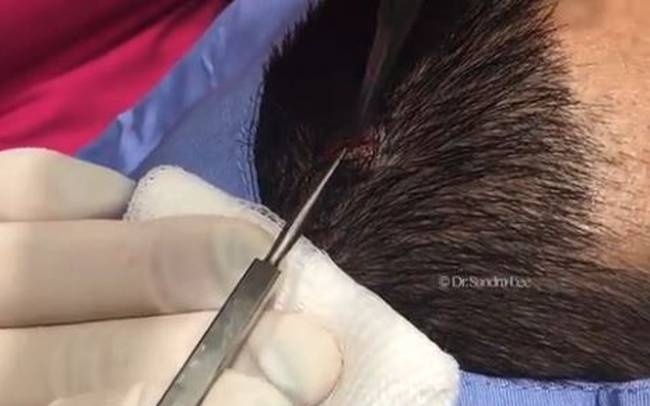 Δεν φαντάζεστε τι σιχαμερό έκρυβε το «κέρατο» που φύτρωσε στο κεφάλι του (video+photos)