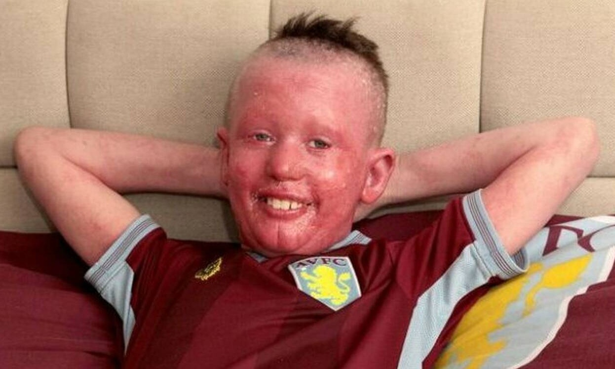 Τον φωνάζουν «Διάβολο» όμως είναι κατακόκκινος από σπάνια αρρώστια (photos+video)