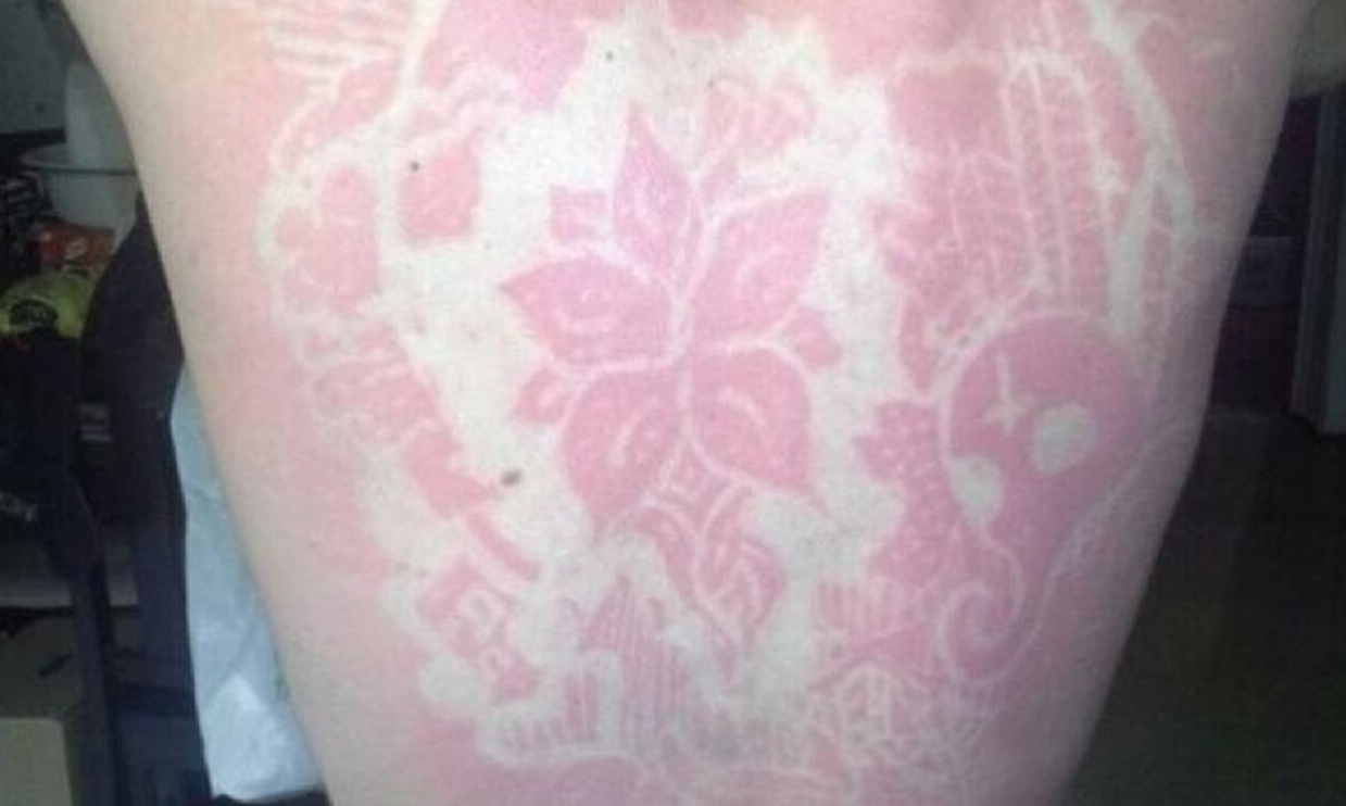 Τατουάζ από… ήλιο – Η επικίνδυνη «μόδα» που κάνει το γύρο του διαδικτύου (photos+video)