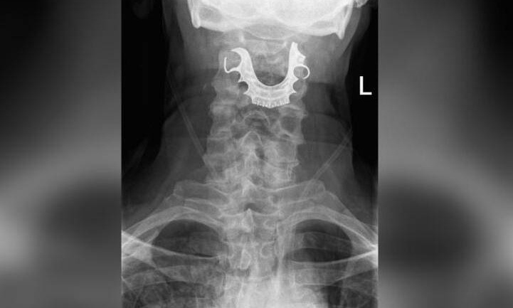 Απίστευτο ιατρικό λάθος: Ασθενής έφυγε από το νοσοκομείο με μασέλα κολλημένη στο λαιμό του