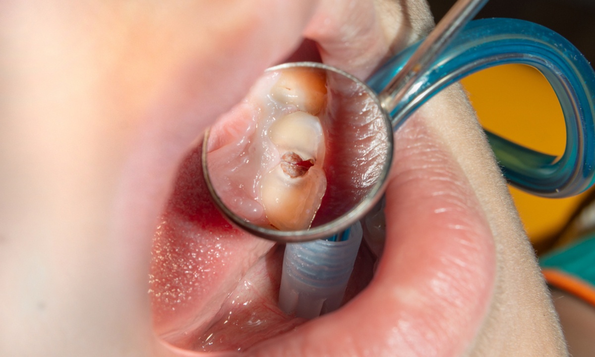 Τερηδόνα: 7 τροφές για λιγότερα σφραγίσματα (εικόνες)