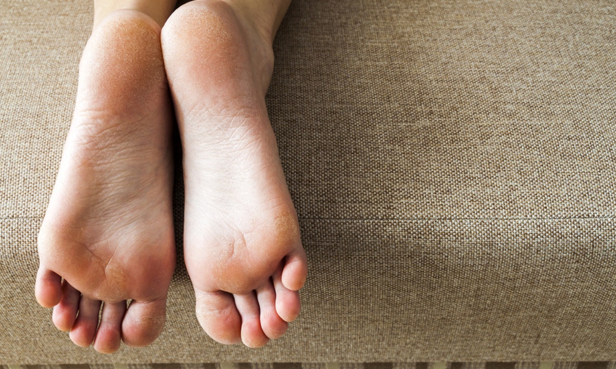 4 δερματικές παθήσεις των ποδιών και τα συμπτώματά τους (εικόνες)