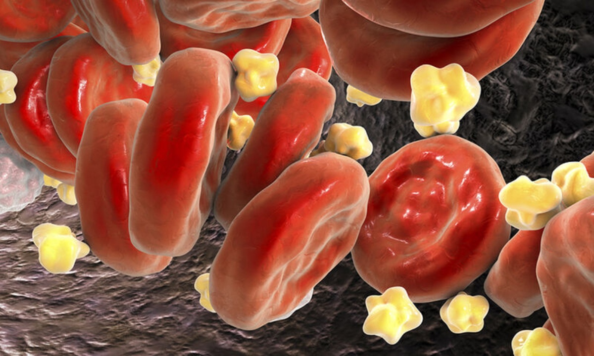 Υψηλή χοληστερόλη: 6 λόγοι σε εικόνες