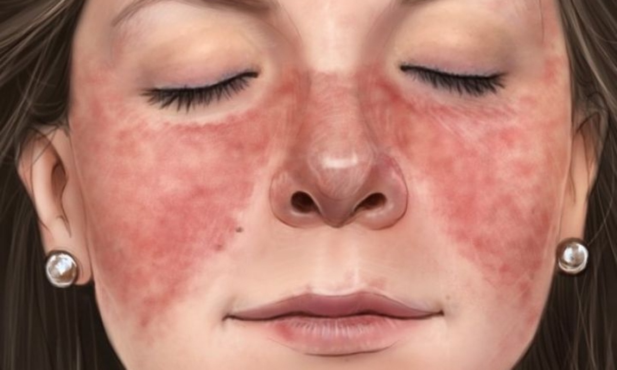 Συστηματικός Ερυθηματώδης Λύκος: 4 αιτίες του σοβαρού αυτοάνοσου (εικόνες)