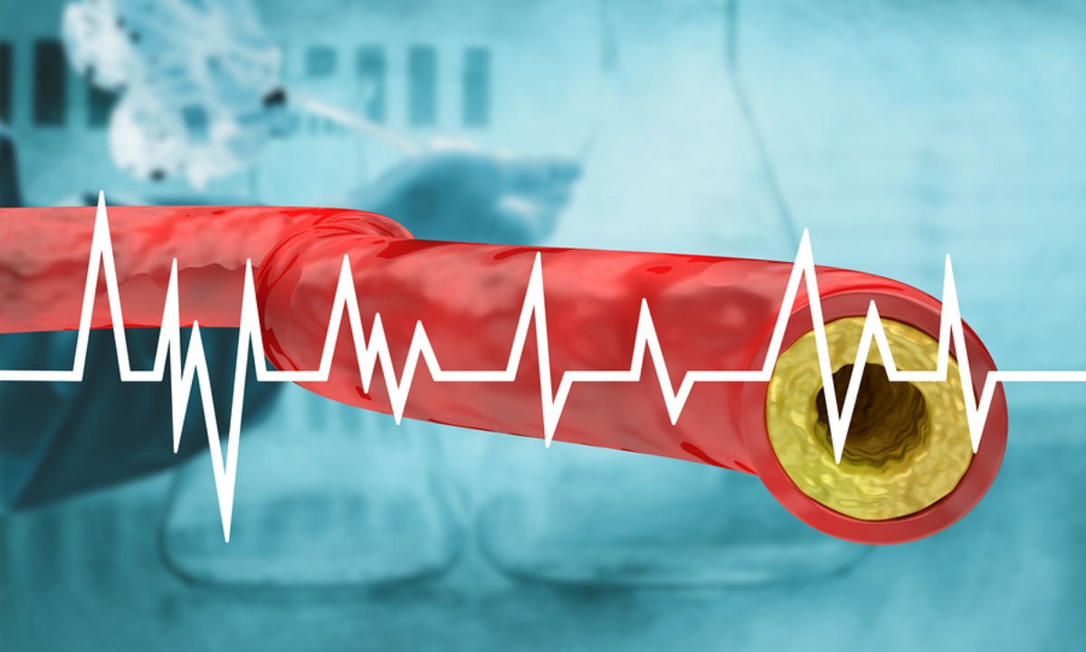 Υψηλή χοληστερόλη: 7 σημάδια που δεν πρέπει να αγνοείτε (video)