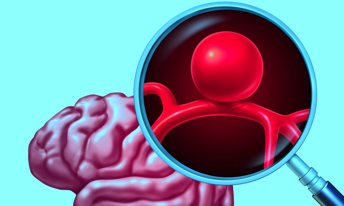 Ανεύρυσμα: Οι κύριες αιτίες ρήξης (εικόνες)