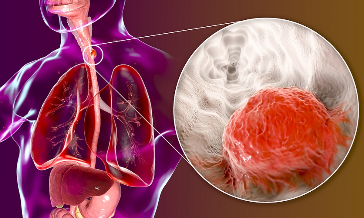 Καρκίνος οισοφάγου: Πώς θα μειώσετε τον κίνδυνο (εικόνες)