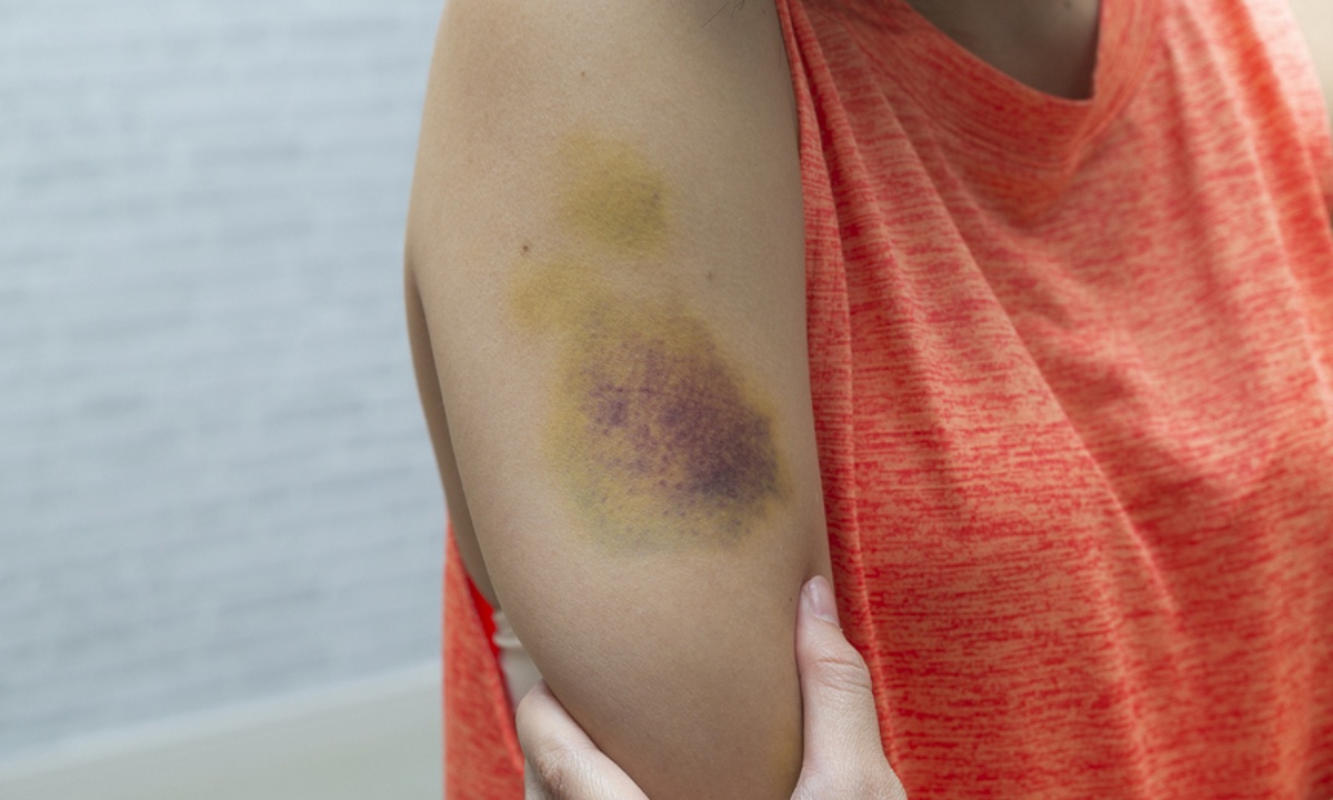 Μελανιάζετε εύκολα; Δείτε τις πιθανές αιτίες (εικόνες)