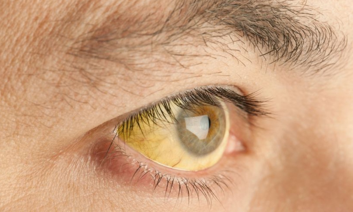 Καρκίνος στο πάγκρεας: 7 άγνωστα συμπτώματα του πιο θανατηφόρου καρκίνου (φωτο)