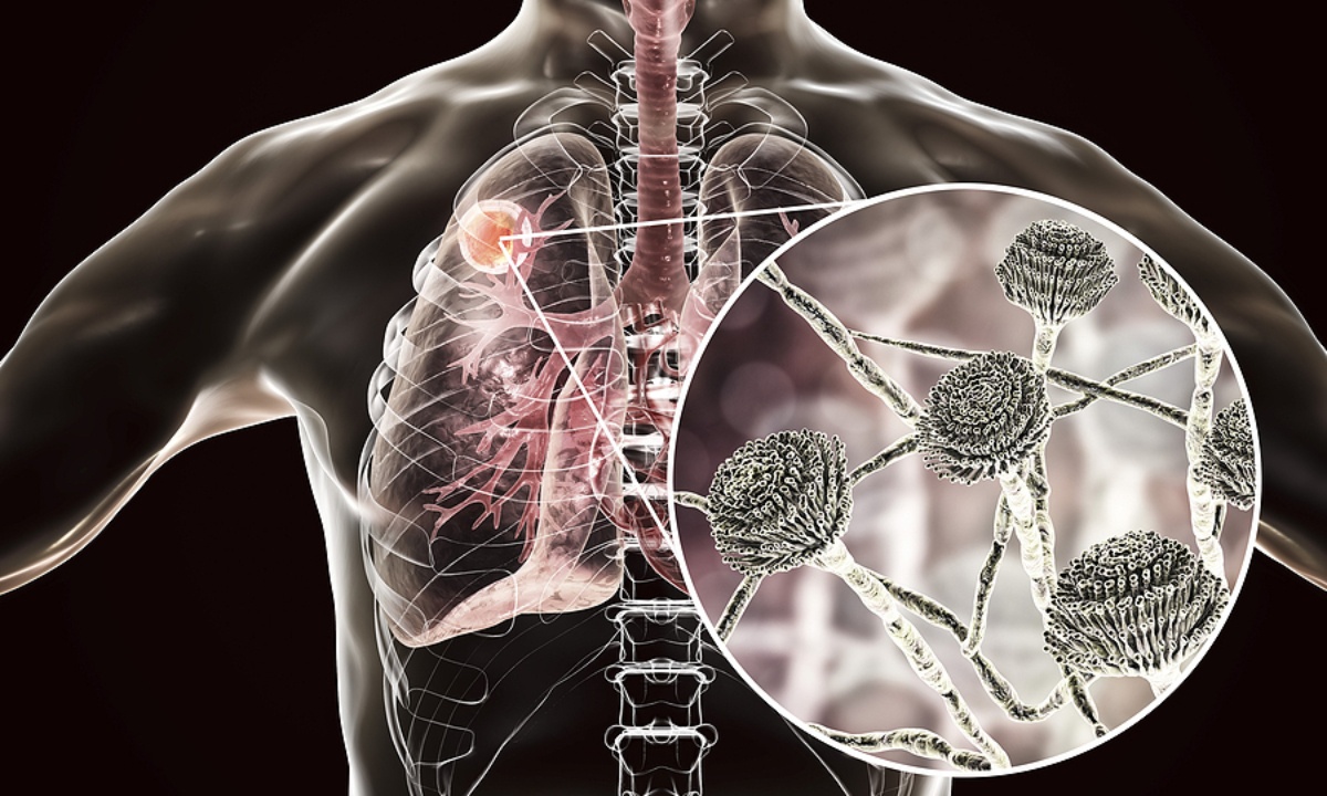 Απόστημα πνεύμονα: Με ποια συμπτώματα εκδηλώνεται (εικόνες)