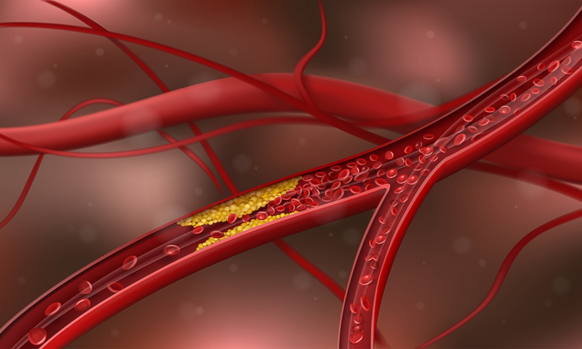 Απόφραξη αρτηριών: Τα προειδοποιητικά σημάδια που πρέπει να γνωρίζετε (εικόνες)