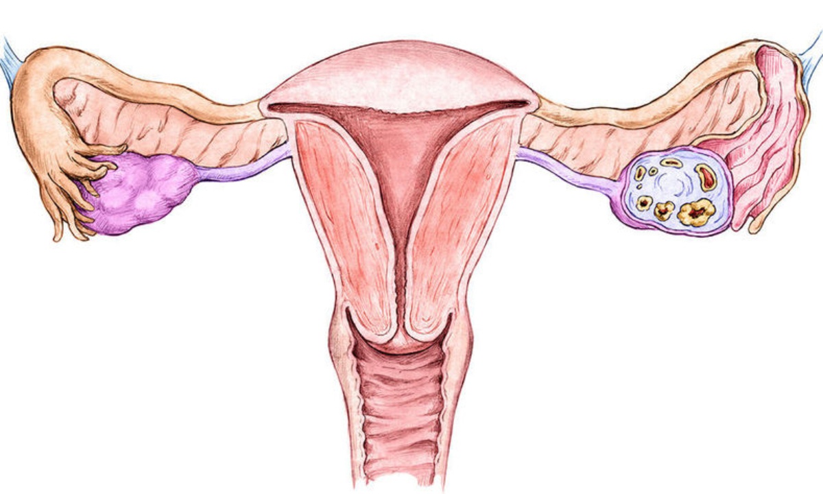 Καρκίνος ενδομητρίου: Τα γενικά συμπτώματα που πρέπει να γνωρίζετε (εικόνες)