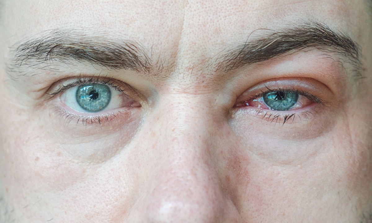 Πρήξιμο ματιών: Πού μπορεί να οφείλεται (εικόνες)