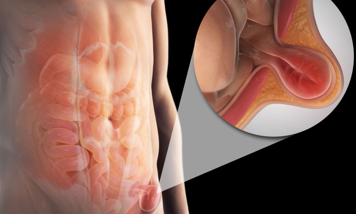 Βουβωνοκήλη: Τι είναι και από τι μπορεί να προκληθεί (εικόνες)