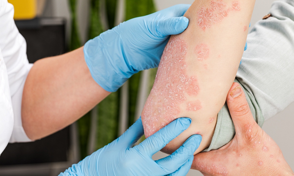 Δερματοπάθειες: Με ποιες άλλες παθήσεις συνδέονται (εικόνες)