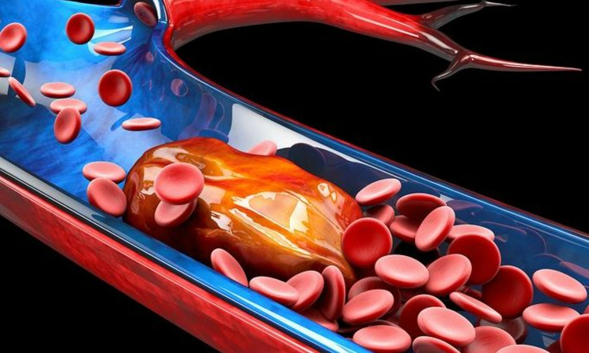 Πώς θα καταλάβετε τη διαφορά μεταξύ μελανιών και θρόμβων αίματος