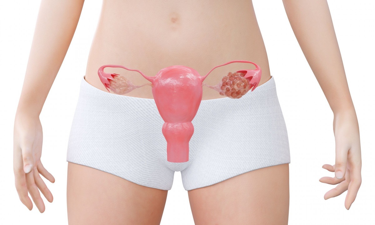 Σύνδρομο πολυκυστικών ωοθηκών & κίνδυνος πρόωρου θανάτου