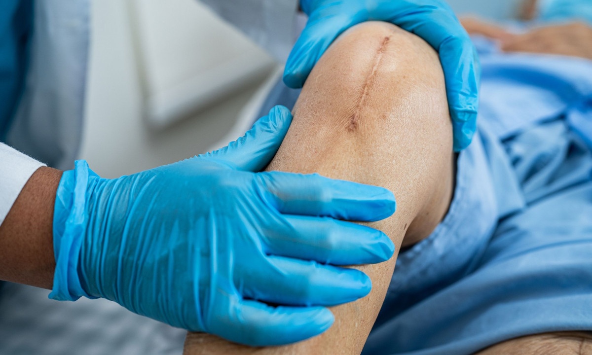 Αντικατάσταση γόνατος: Με ποιες ασκήσεις θα την αποφύγετε