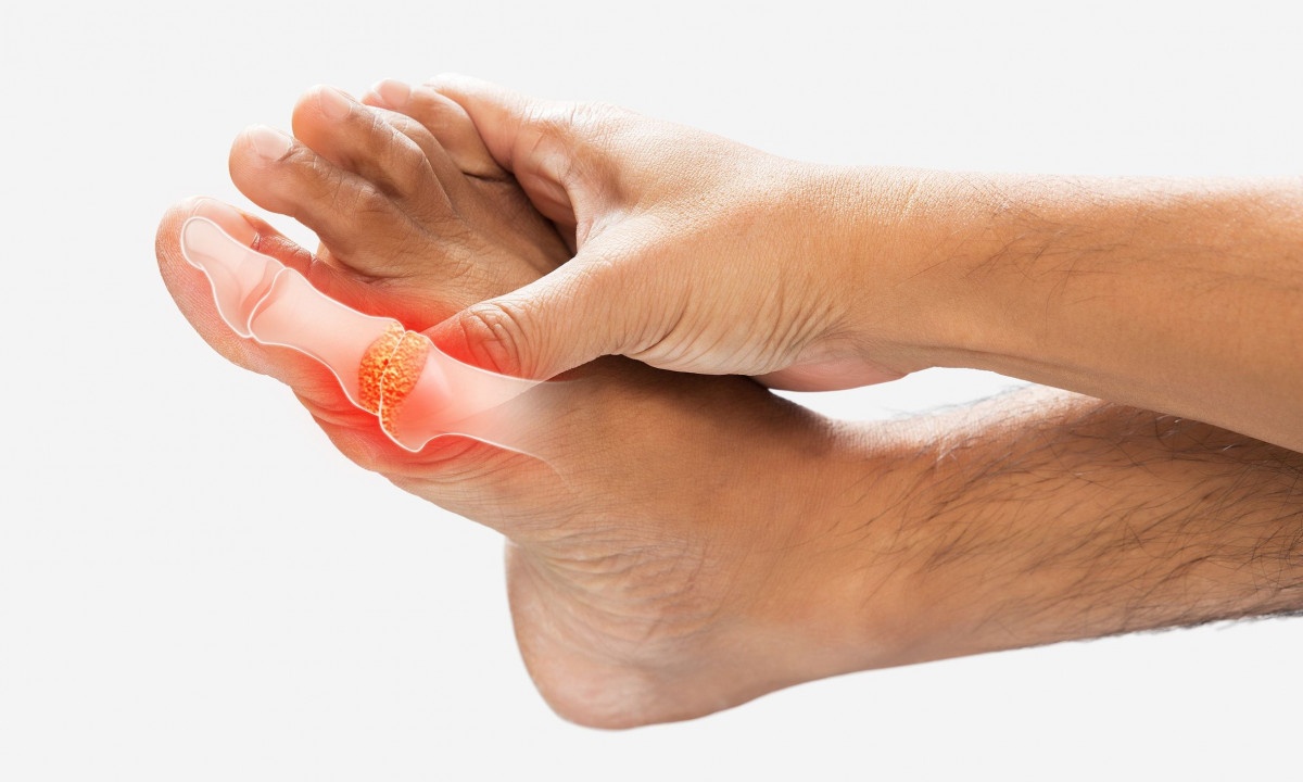 Ποιες αρθρώσεις προσβάλλει η ουρική αρθρίτιδα