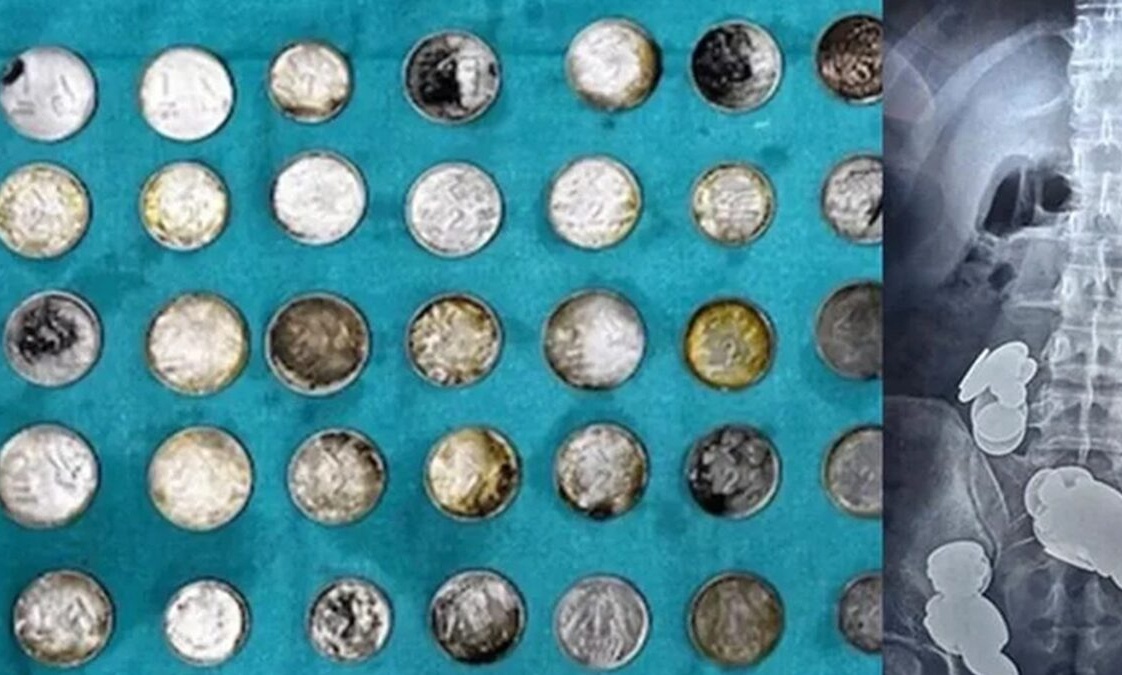 Κατάπιε κέρματα και μαγνήτες για να «χτίσει» σώμα: Άκουσε ότι ο ψευδάργυρος βοηθάει στο bodybuilding