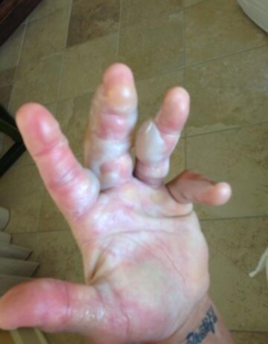 Ανατριχιαστικός τραυματισμός του Hulk Hogan (photos)