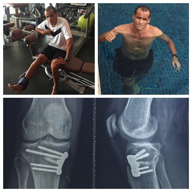 Σοκ! Γεμάτο βίδες το πόδι του Ριβάλντο! (photo)