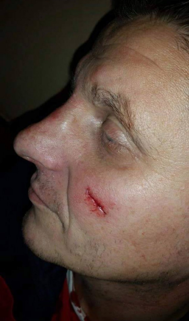 Εικόνες σοκ! Αλβανοί χούλιγκαν μαχαίρωσαν σε Σέρβους οπαδούς!