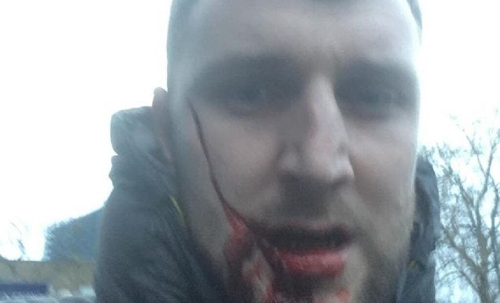 Σοκάρει η εικόνα του προσώπου του μαχαιρωμένου οπαδού της Έβερτον (photos+videos)