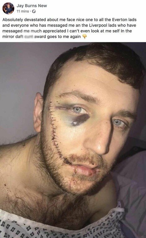 Σοκάρει η εικόνα του προσώπου του μαχαιρωμένου οπαδού της Έβερτον (photos+videos)