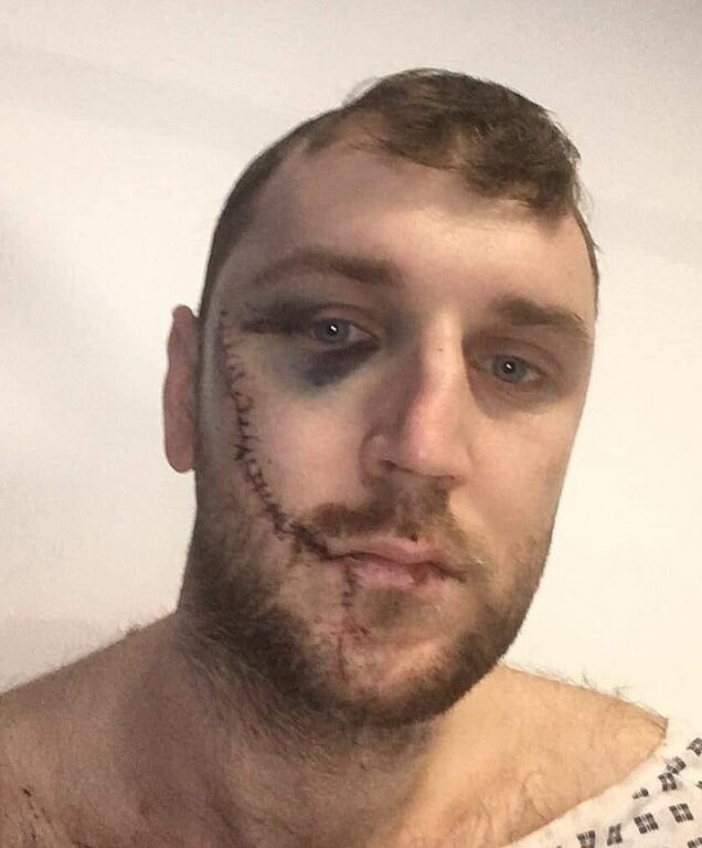 Σοκάρει η εικόνα του προσώπου του μαχαιρωμένου οπαδού της Έβερτον (photos+videos)