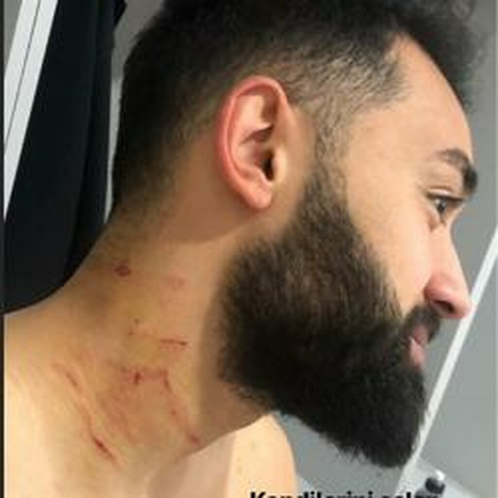 «Καμπάνα» στον παίκτη που επιτέθηκε με ξυραφάκι στον αντίπαλο του στην Τουρκία (photo)