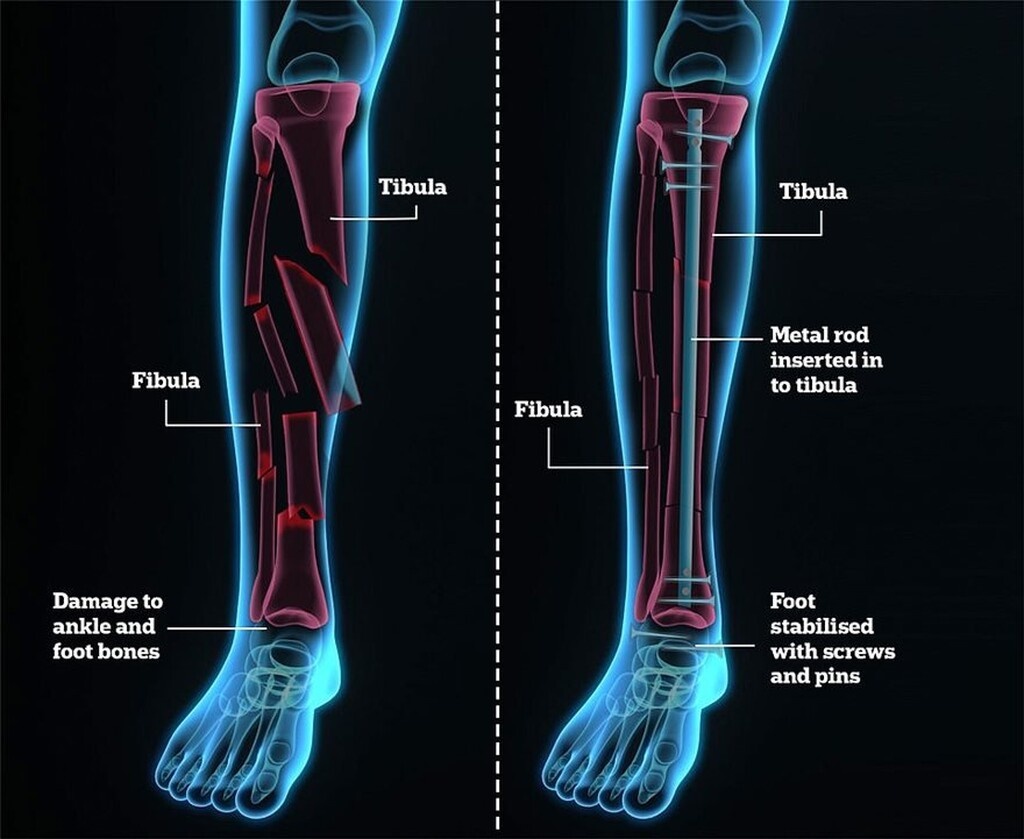 Σοκάρει ο τραυματισμός του Τάιγκερ Γουντς - Κίνδυνος για την καριέρα του (photos+video)