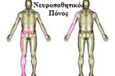 Νευροπαθητικός πόνος