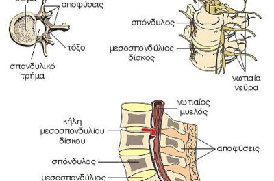 Διαδερμική δισκεκτομή με διοδικό LASER-Kήλη του μεσοσπονδυλίου δίσκου