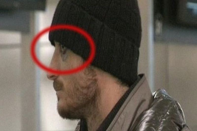 Το πρησμένο μάτι του Ριέρα!