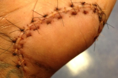 Λίγο έλειψε να κοπεί το νεύρο του Αμάρε! (photo)